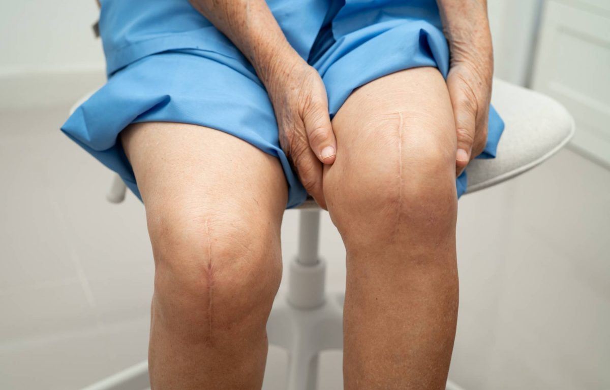 A person sitting on a white stool wearing blue garments. Their knees have vertical scars from knee replacement surgery.