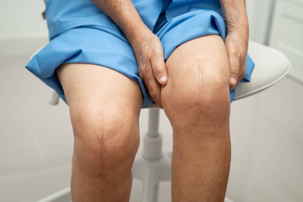 A person sitting on a white stool wearing blue garments. Their knees have vertical scars from knee replacement surgery.